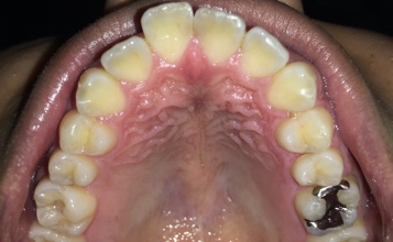 前歯部叢生　治療前写真1
