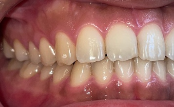 前歯部叢生　治療前写真6