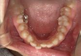 前歯部叢生　治療前写真3