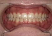 前歯部叢生　治療前写真4
