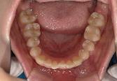 前歯部叢生　治療前写真3