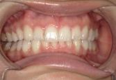 前歯部叢生　治療前写真4