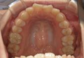 前歯部叢生　治療前写真2