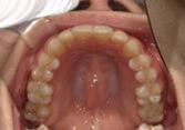 前歯部叢生　治療前写真5