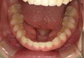 前歯部叢生　治療前写真6