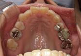 前歯部叢生　治療前写真2