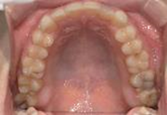 前歯部叢生　治療前写真5