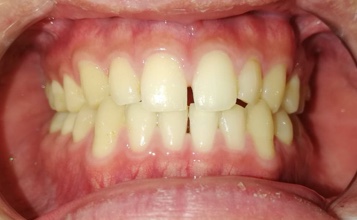空隙歯列を伴う叢生　治療前写真2