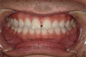 空隙歯列を伴う叢生　治療前写真1