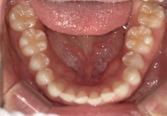 空隙歯列を伴う叢生　治療前写真3