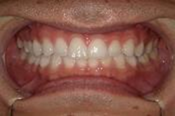 空隙歯列を伴う叢生　治療前写真4