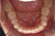 空隙歯列を伴う叢生　治療前写真6