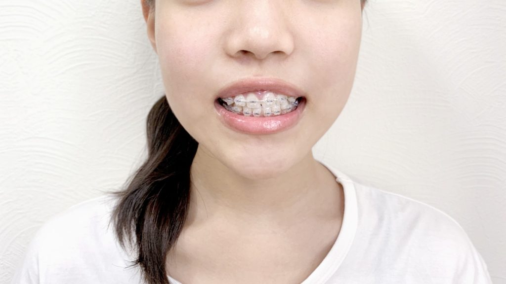 ワイヤー矯正 ブラケット